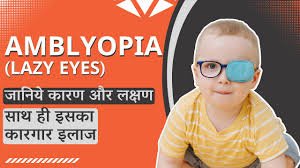 Amblyopia in kids | Lazy eyes | Causes & treatment