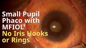 Technique to operate and implant multi focal IOL