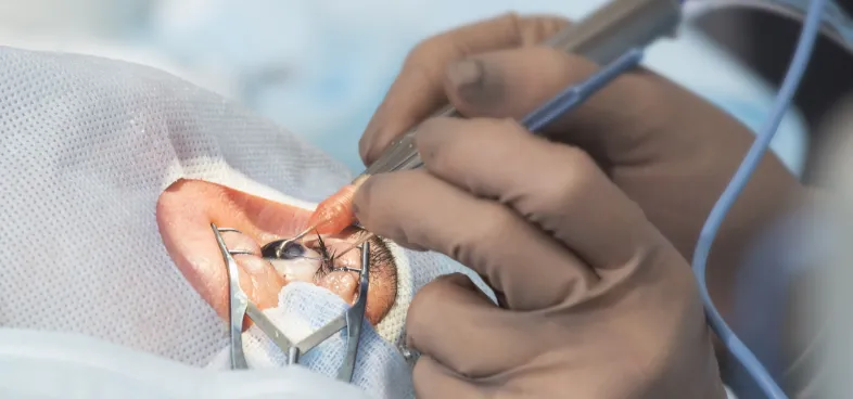 Microincision Cataract Surgery