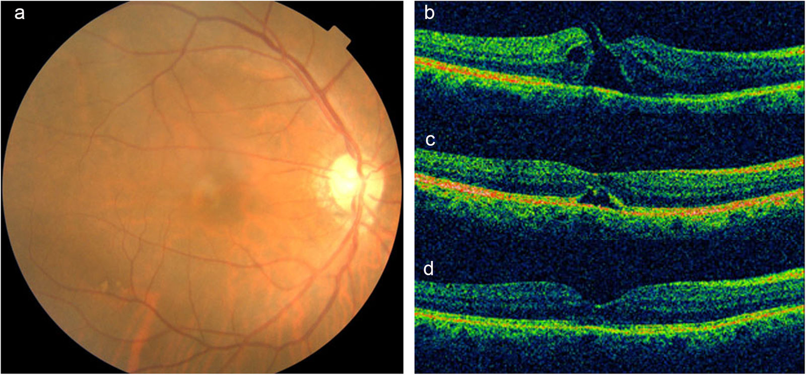 Macular Hole Treatment