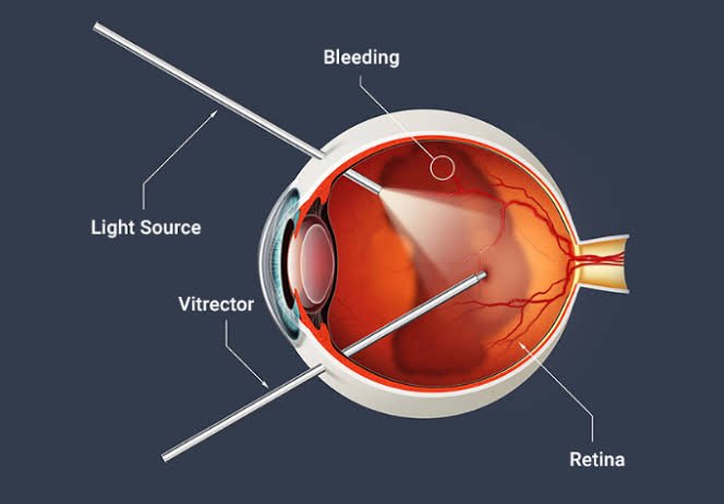 Retina & Vitreous Surgery