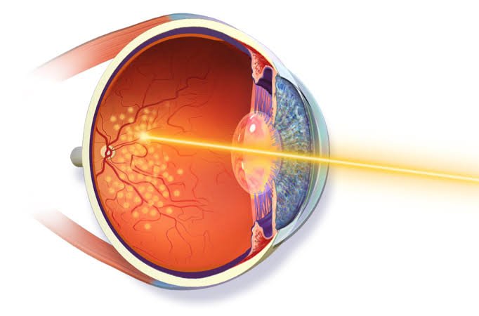 Retina Tears or Hole Treatment