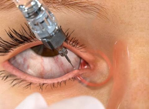 Punctal Plugs Treatment