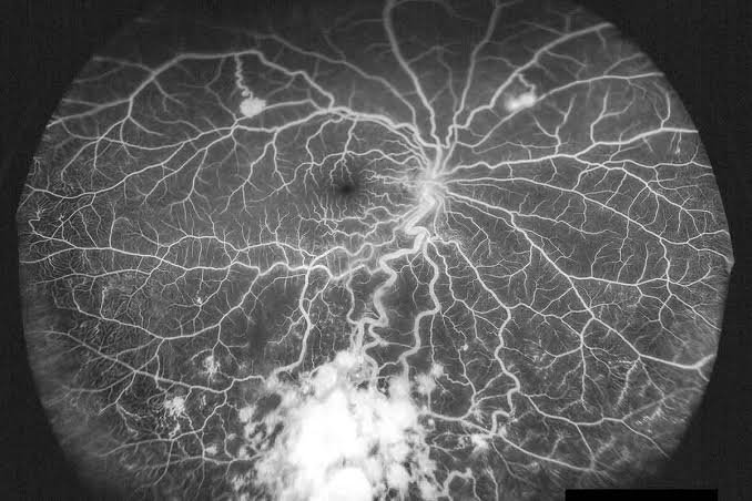 Fluorescein Angiography