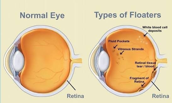 Eye Floaters Treatment
