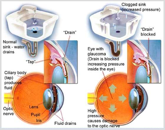 Glaucoma Treatment in Delhi