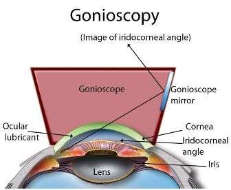 Gonioscopy Principle