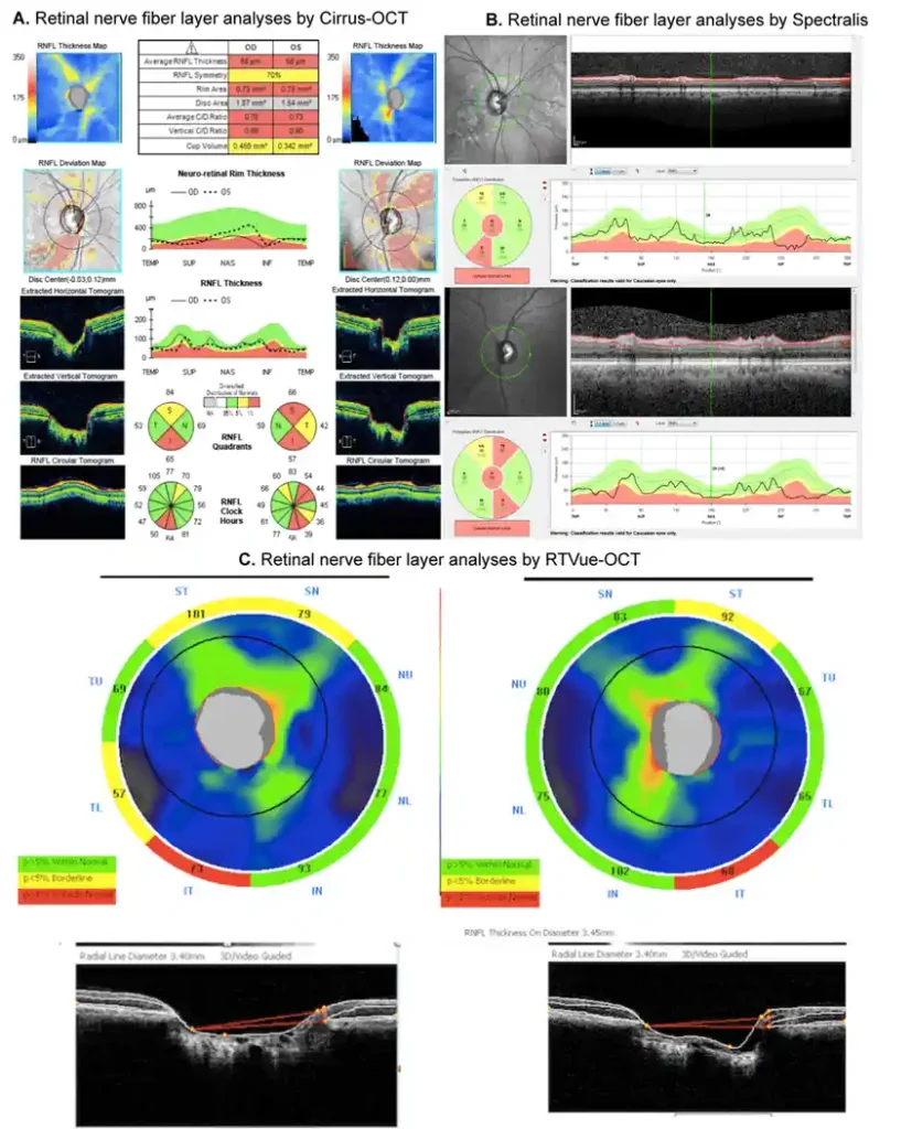 OCT- RNFL