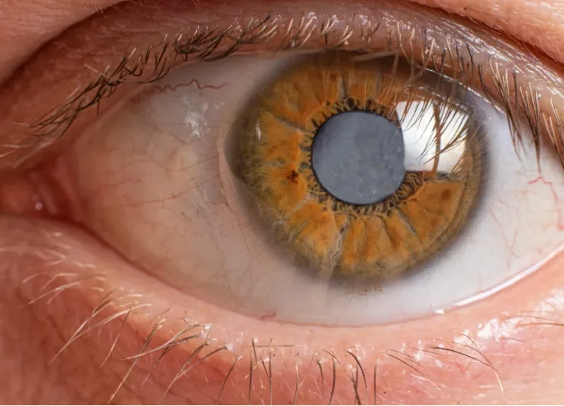 cataract at Best Eye Hospital in East Delhi