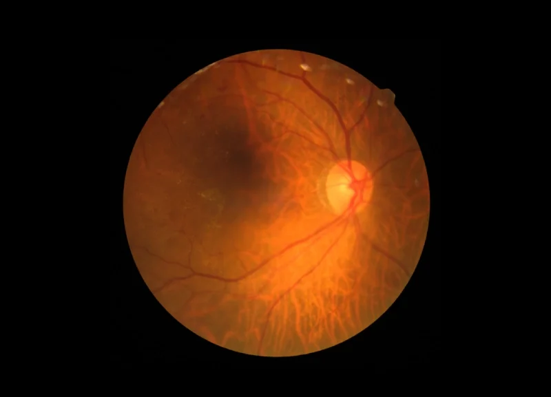 diabetic retinopathy at Best Eye Hospital in East Delhi