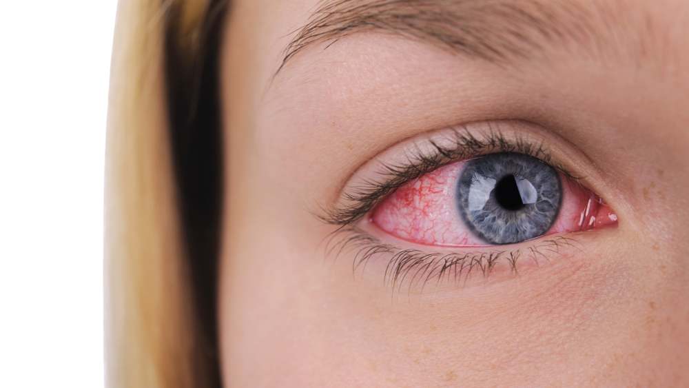 Corneal Abrasion
