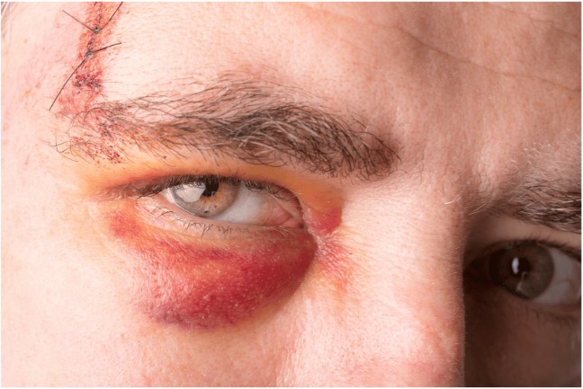 How to Respond to Eye Injuries: Immediate Steps