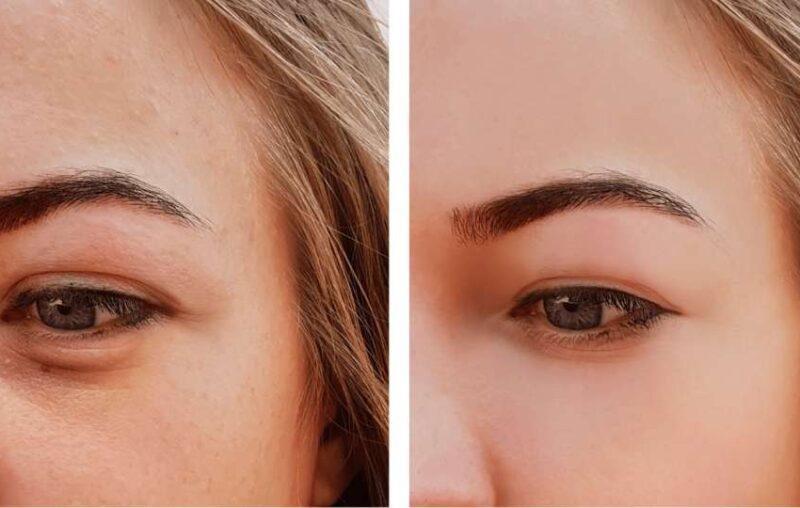 Swollen Eyelids: Causes and How to Reduce Them