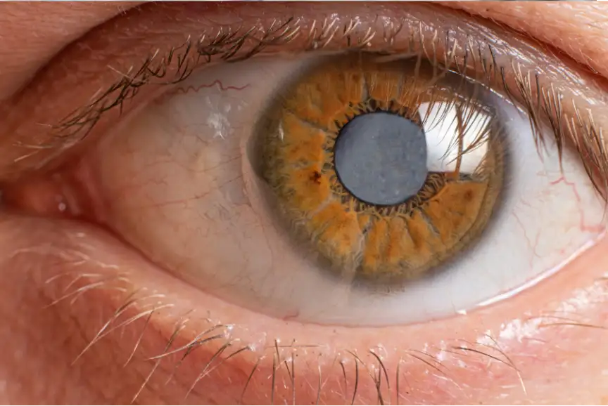 eye health cataract at Best Eye Hospital in East Delhi
